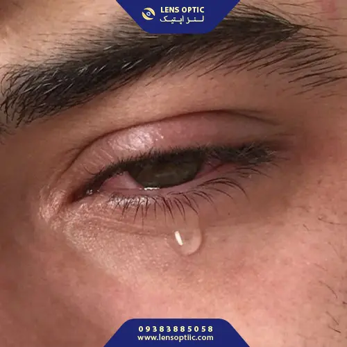 خشکی چشم